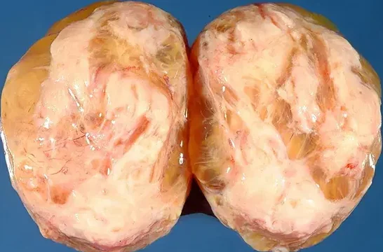 LEIOMYOMA WITH MYXOID CHANGE