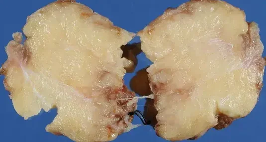 LIPOBLASTOMA