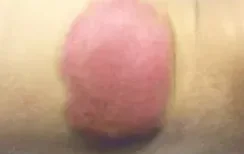 LIPOFIBROMATOSIS