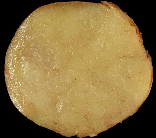 LIPOMA