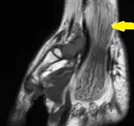 NEURAL FIBROLIPOMA