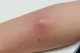 NODULAR FASCIITIS