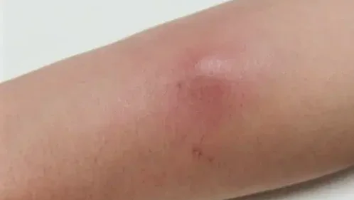 NODULAR GASCIITIS