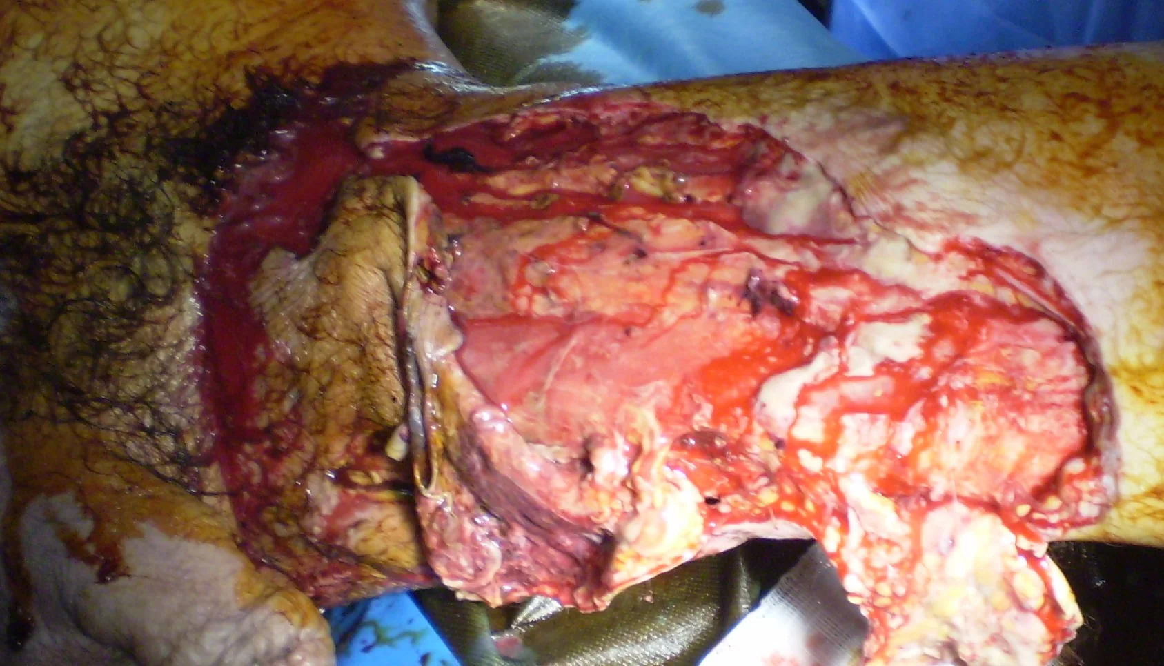 FOURNIER'S GANGRENE - SURGERY