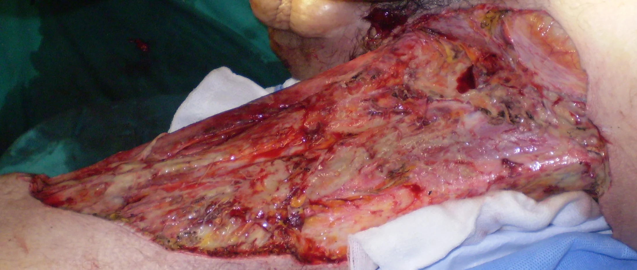 FOURNIER'S GANGRENE - SURGERY