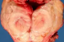PERIPHERAL NERVE SHEATH TUMOR