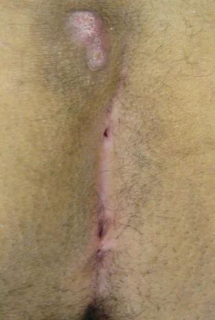PILONIDAL SINUS