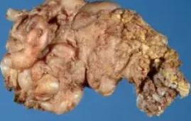 PLEXIFORM NEUROFIBROMA
