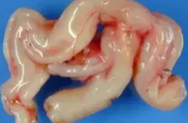 PLEXIFORM NEUROFIBROMA 