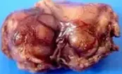 SCHWANNOMA