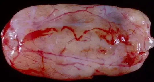 SCHWANNOMA 