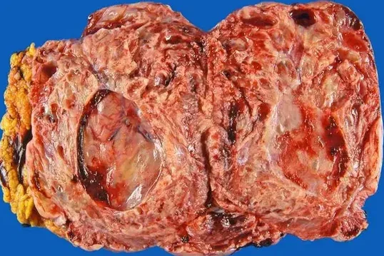 SOLITARY FIBROUS TUMOR