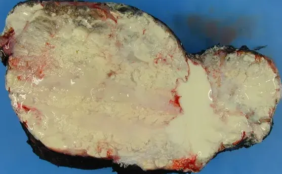 TUMORAL CALCINOSIS