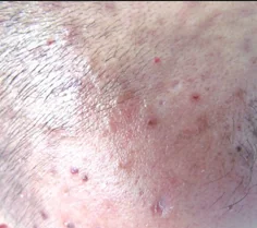 SKIN LYMPHOMA 