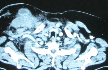 LYMPHOMA DEEP TO THE PECTORALIS MAJOR MUSCLE