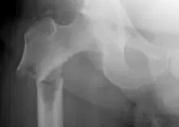 MYELOMA - PATHOLOGICAL FRACTURE