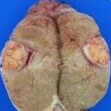 TESTICULAR LYMPHOMA