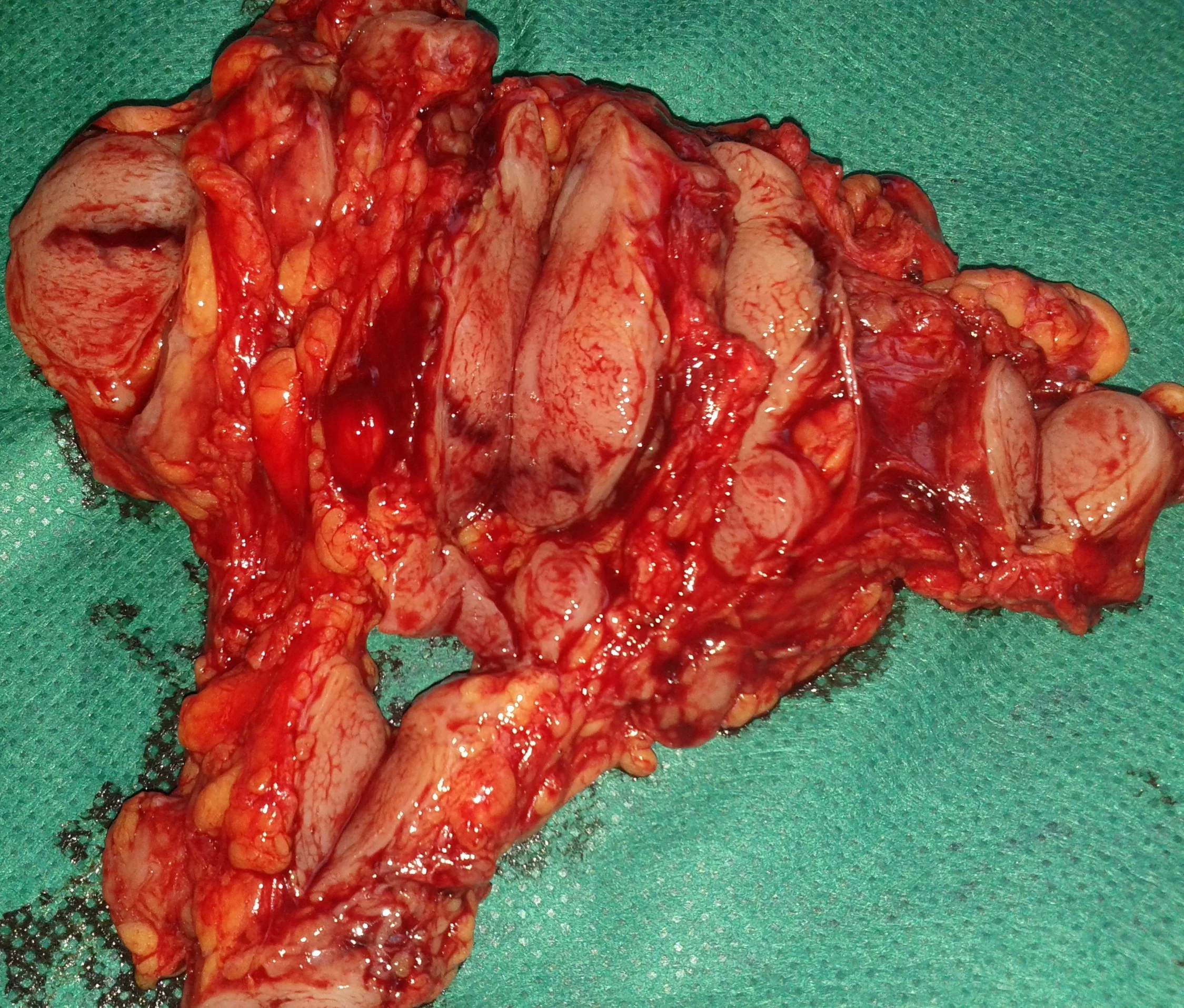 AXILLARY LYMPHOMA