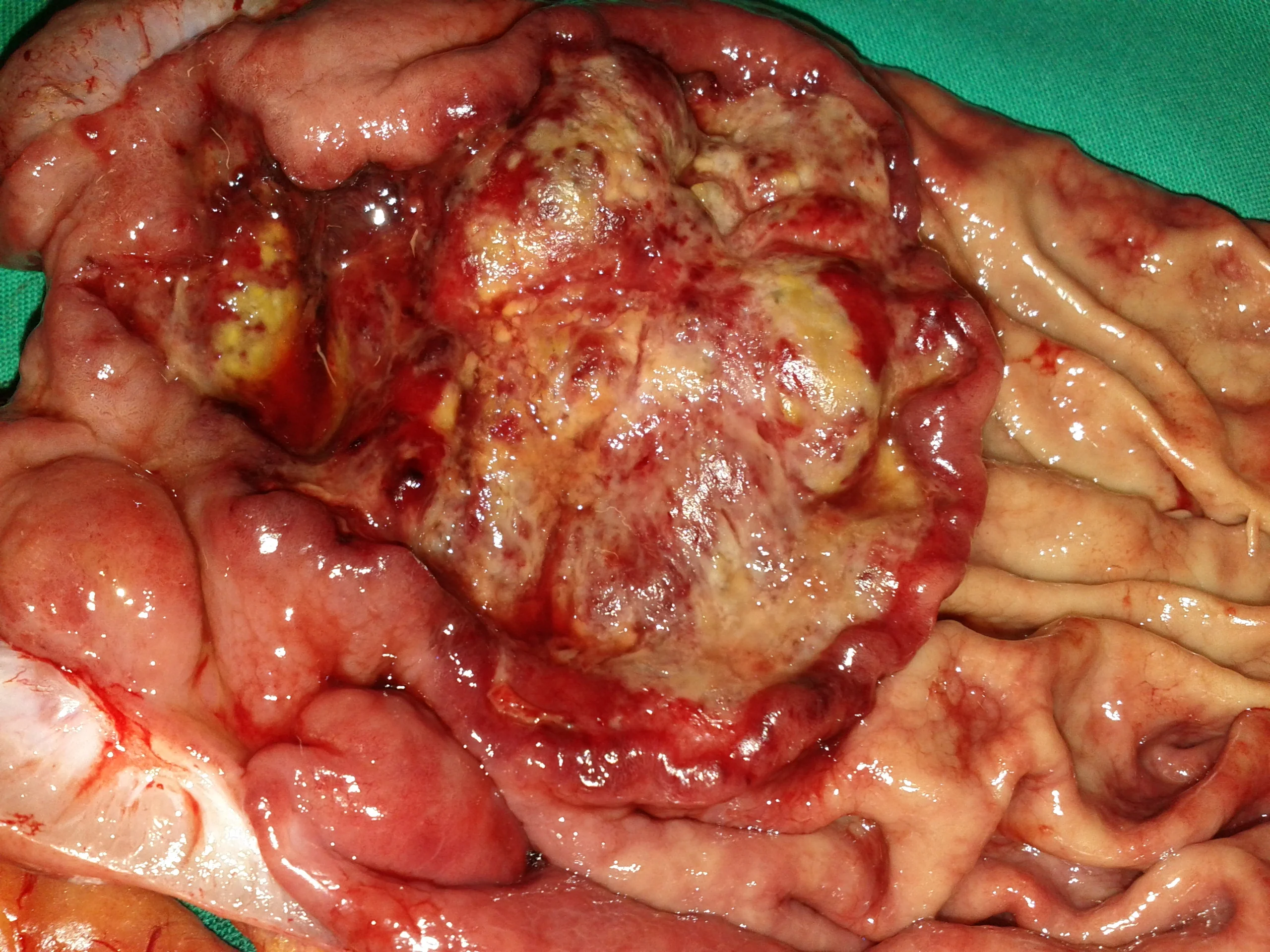 GASTRIC LYMPHOMA