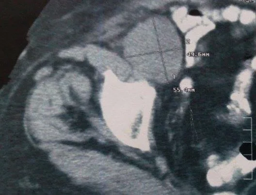 PELVIC LYMPHOMA