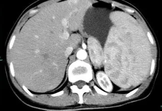 SPLENIC LYMPHOMA