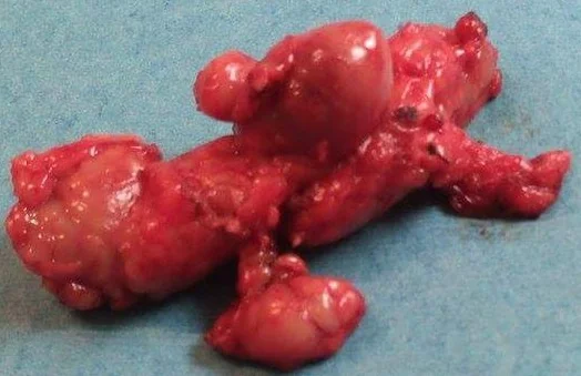 LYMPHOMA - INGUINAL LYMPH NODES