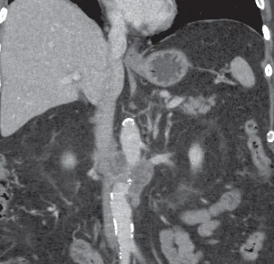 PANCREATIC LYMPHOMA INVADING IVC