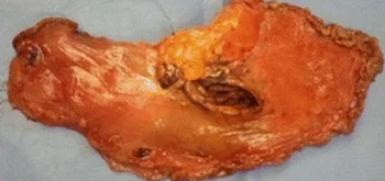 GASTRIC LYMPHOMA PERFORATION