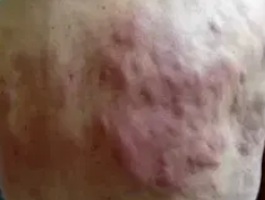 ANGIOIMMUNOBLASTIC T - CELL LYMPHOMA