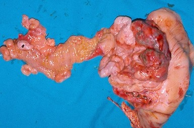 SMALL BOWEL LYMPHOMA