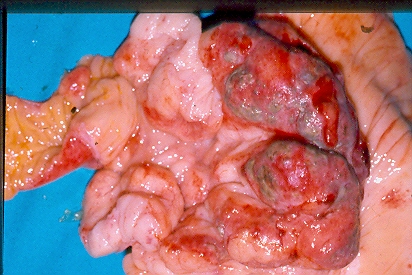 SMALL BOWEL LYMPHOMA