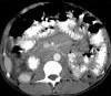 BOWEL LYMPHOMA