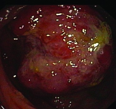 CECAL LYMPHOMA