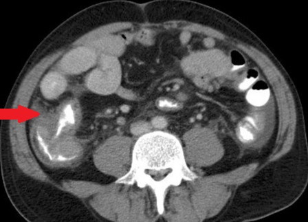CECAL LYMPHOMA