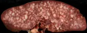 CHRONIC LYMPHOCYTIC LEUKEMIA - SPLENECTOMY