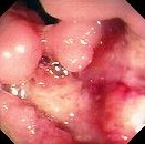COLONIC LYMPHOMA