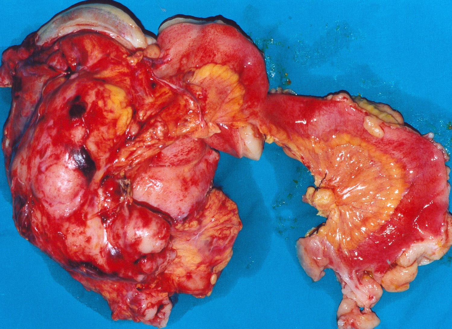 CECAL LYMPHOMA - RIGHT HEMICOLECTOMY