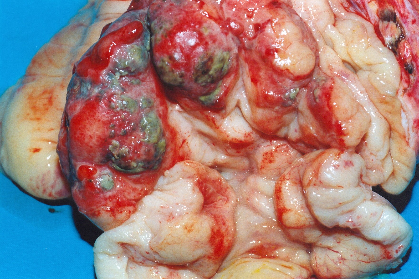CECAL LYMPHOMA