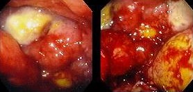 GASTRIC LYMPHOMA