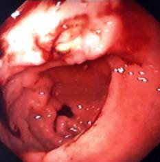 GASTRIC LYMPHOMA