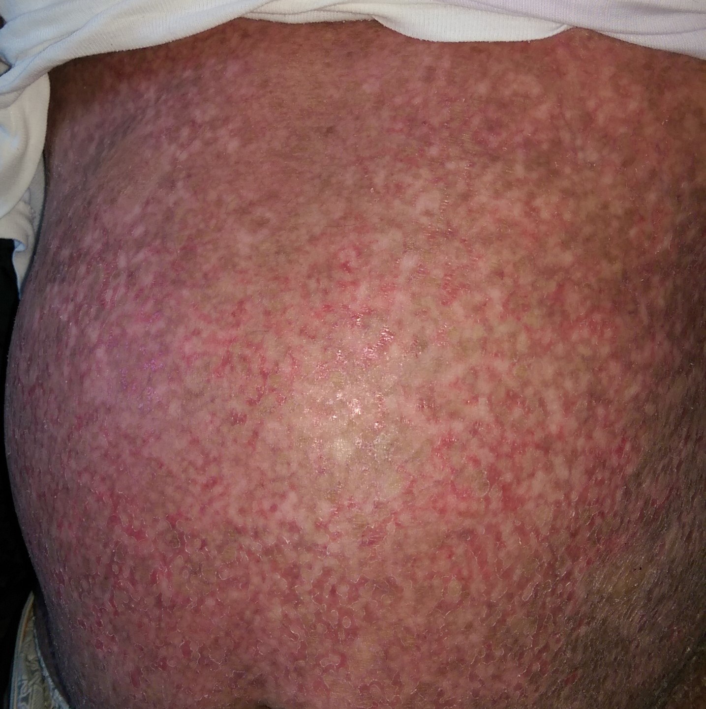 GRAFT VERSUS HOST DISEASE