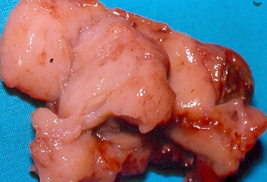 ADRENAL LYMPHOMA