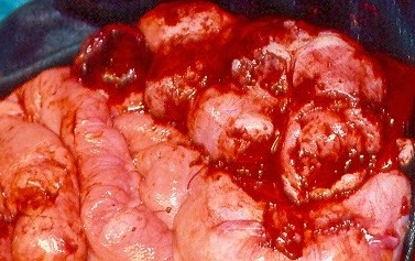 SMALL BOWEL LYMPHOMA
