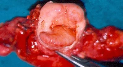 LARGE BOWEL LYMPHOMA