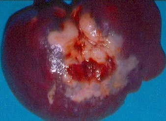 SPLENIC LYMPHOMA