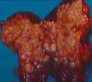 SPLENIC LYMPHOMA