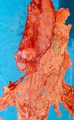 GASTRIC LYMPHOMA