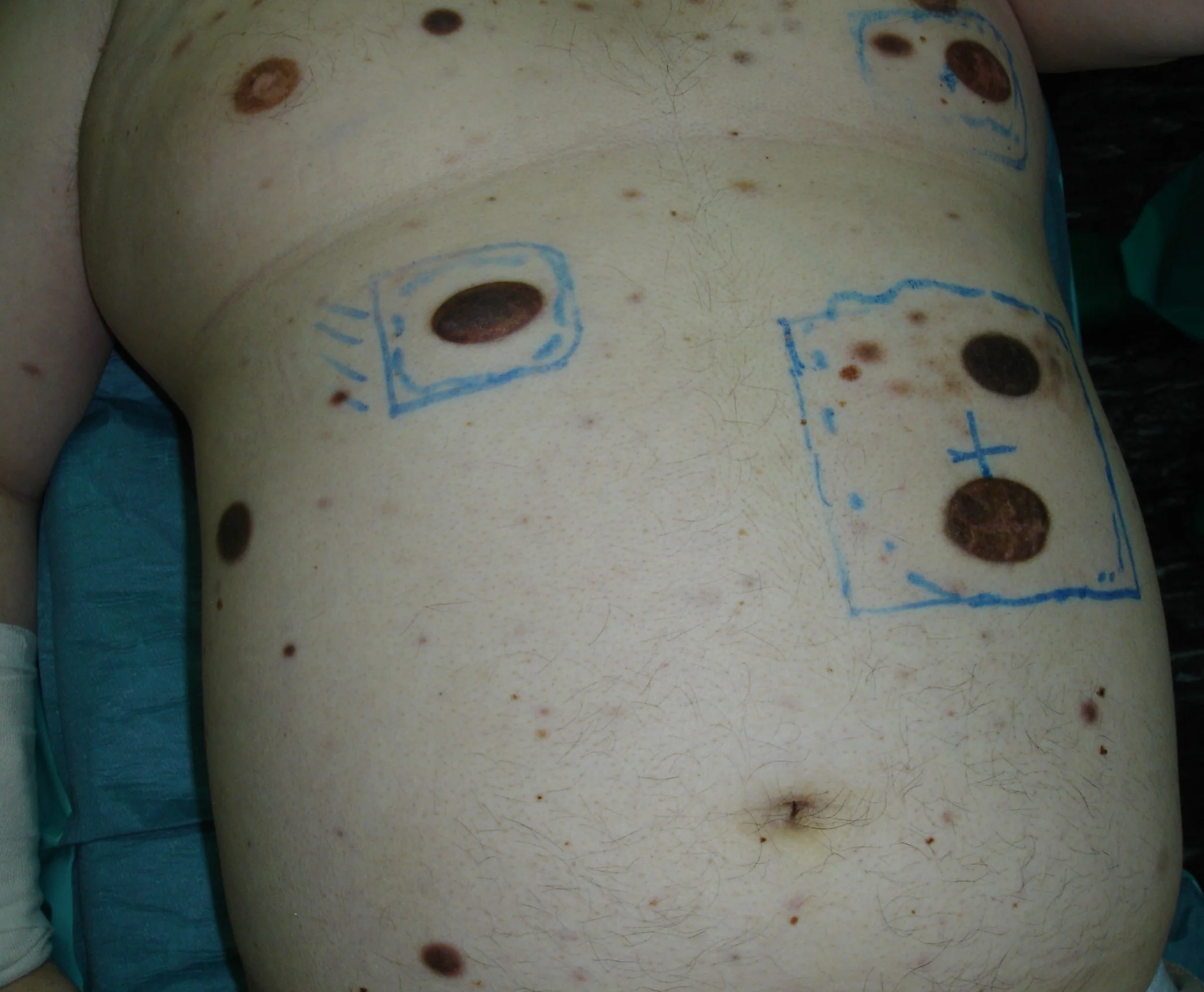 POST BMT LYMPHOMA