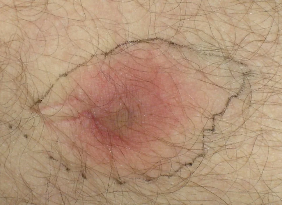 LEUKEMIA - CHLOROMA