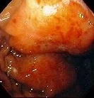 MALT LYMPHOMA 